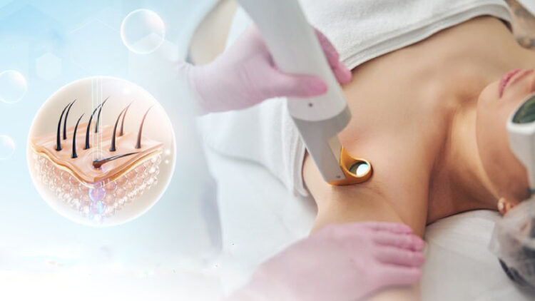 Wax lông có làm lông mọc nhiều hơn không